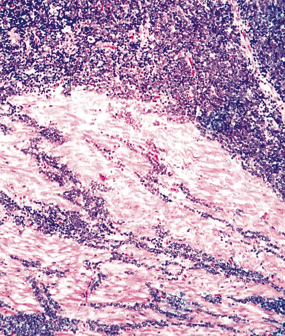 Pathology Outlines Neuroendocrine tumor / carcinoma